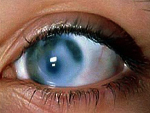 ظاهر چشم در بیماری آب سیاه گلوکوم