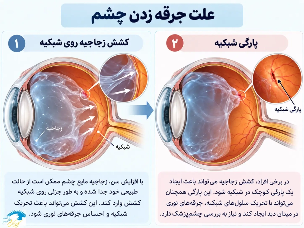 کشش زجاجیه روی شبکیه و پارگی شبکیه از علت_های جرقه زدن چشم