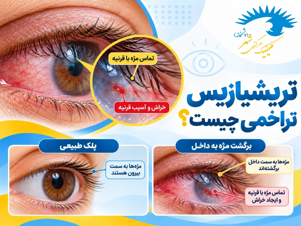 تریشیازیس تراخمی و تماس مژه_های برگشته با قرنیه