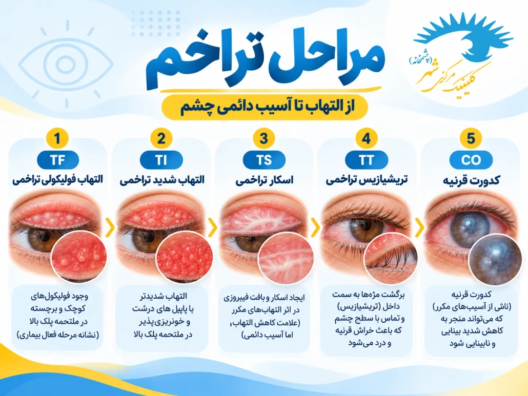 مراحل تراخم شامل TF، TI، TS، TT و کدورت قرنیه