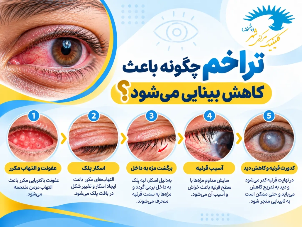 مراحل پیشرفت تراخم از عفونت مکرر تا آسیب قرنیه و کاهش بینایی