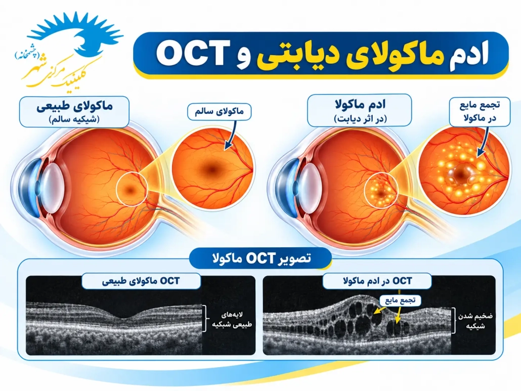 ادم ماکولای دیابتی و تجمع مایع در شبکیه در تصویر OCT