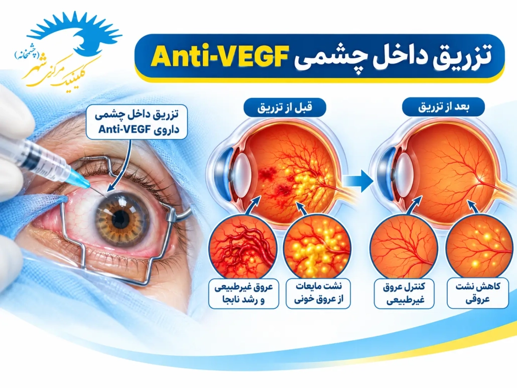 تزریق داخل چشمی Anti-VEGF برای درمان رتینوپاتی دیابتی