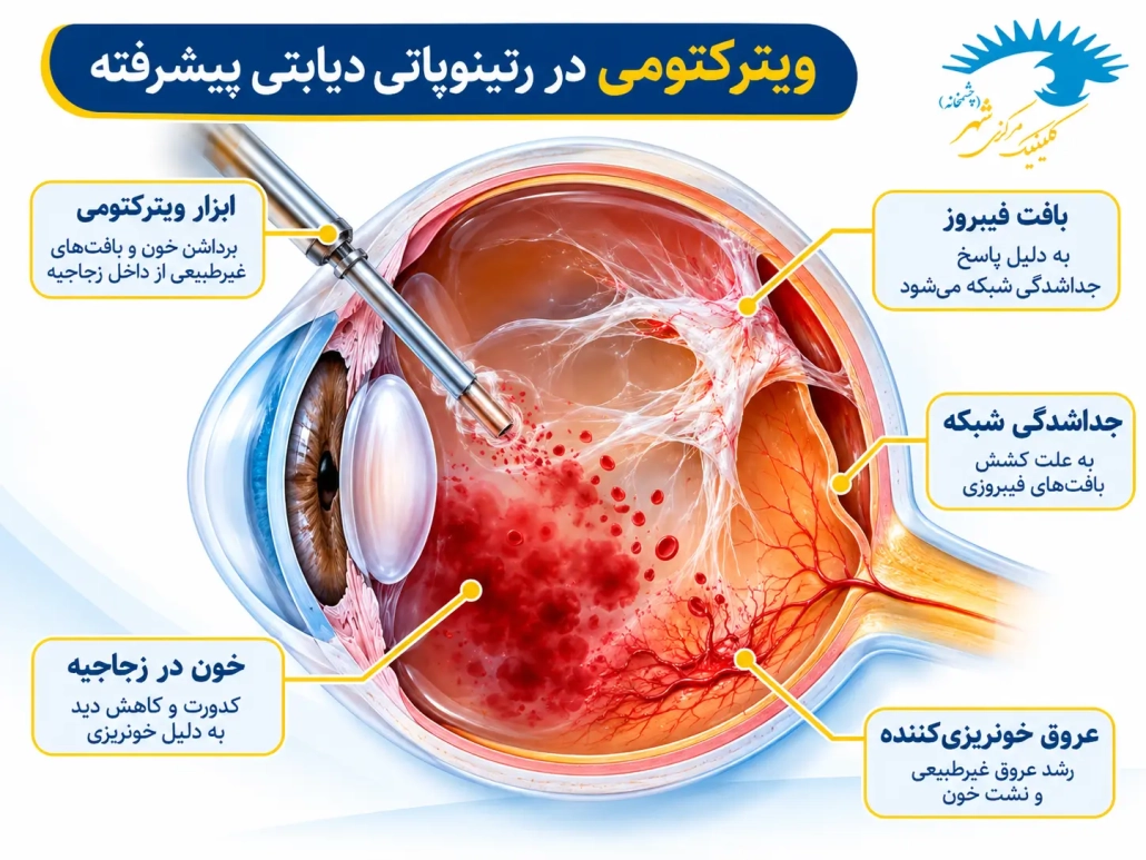جراحی ویترکتومی در رتینوپاتی دیابتی پیشرفته