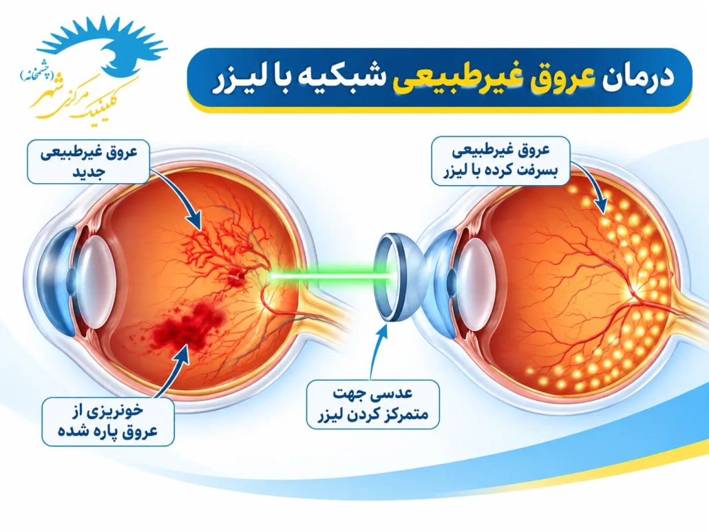درمان عروق غیرطبیعی شبکیه با لیزر در رتینوپاتی دیابتی