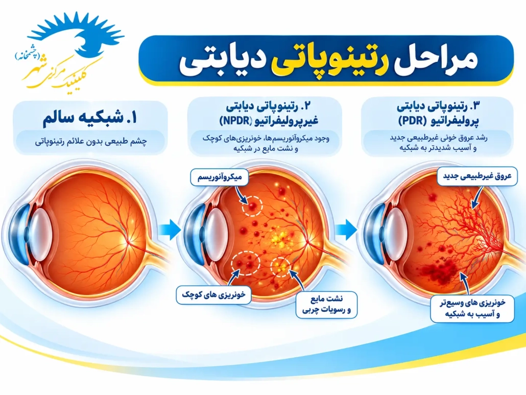 مراحل رتینوپاتی دیابتی از شبکیه سالم تا NPDR و PDR