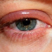 شالازيون (Chalazion)