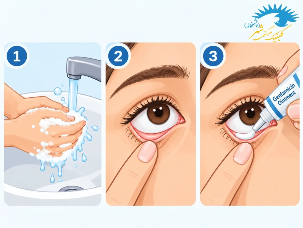آموزش نحوه صحیح استفاده از پماد چشمی جنتامایسین