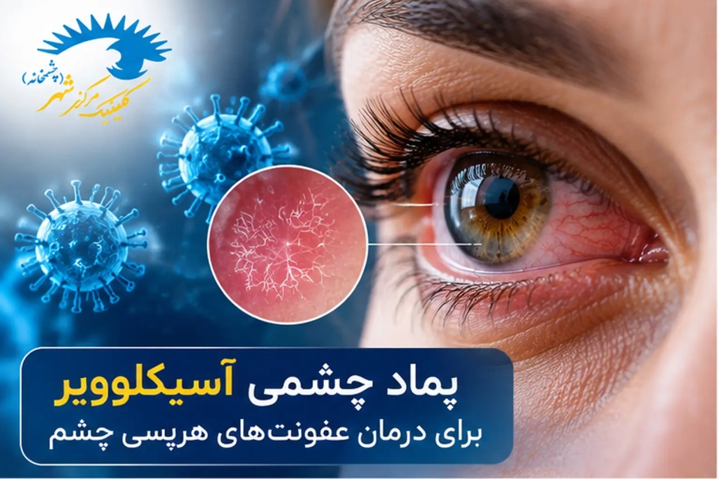 پماد چشمی آسیکلوویر برای درمان عفونت هرپسی چشم