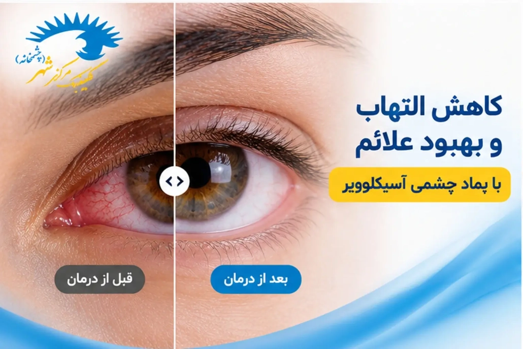 کاهش قرمزی و التهاب چشم با درمان عفونت هرپسی