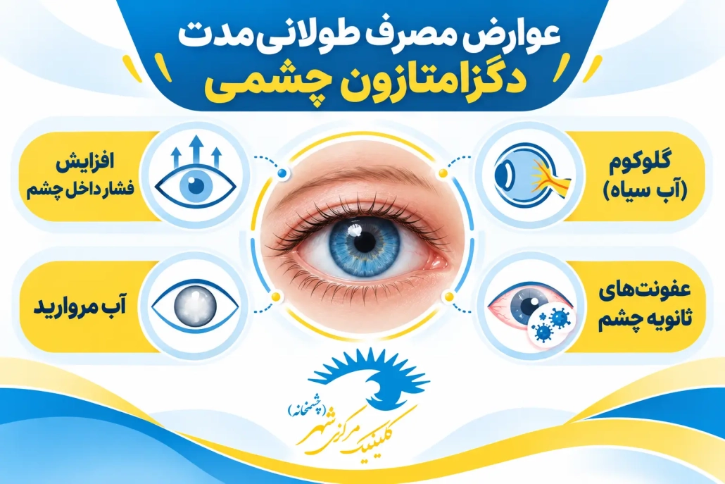 عوارض مصرف طولانی قطره دگزامتازون شامل افزایش فشار چشم و آب مروارید