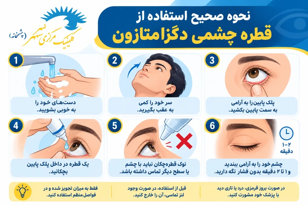 نحوه صحیح استفاده از قطره چشمی دگزامتازون
