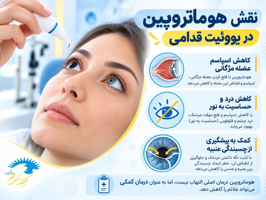 نقش هوماتروپین در کاهش درد و اسپاسم در یووئیت قدامی