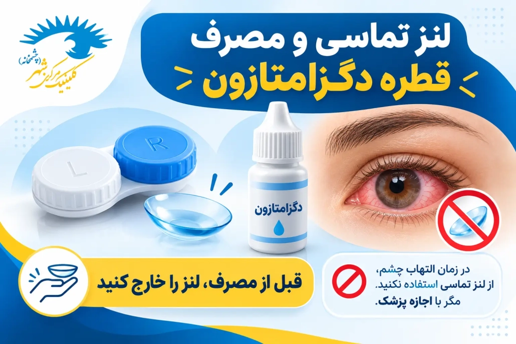 نکات استفاده از لنز تماسی هنگام مصرف قطره چشمی دگزامتازون