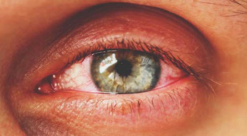 علائم و نشانه‌های تیروئید چشمی